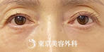 【目の下の脱脂、目の上の脂肪注入｜ak5821】の症例