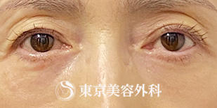 【目の下の脱脂、目の上の脂肪注入｜ak5821】の症例写真 after【2枚目】