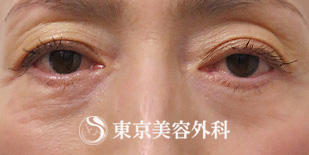 【目の下の脱脂、目の上の脂肪注入｜ak5821】の症例写真 before【1枚目】