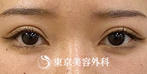 【眼瞼下垂・オープンアイズ、目の上の脂肪取り｜ak6825】の症例
