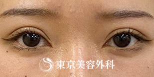 【眼瞼下垂・オープンアイズ、目の上の脂肪取り｜ak6825】の症例写真 after【2枚目】