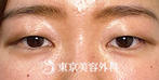 【眼瞼下垂・オープンアイズ、目の上の脂肪取り｜ak6825】の症例