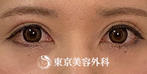 【眼瞼下垂・オープンアイズ、目の上の脂肪取り｜ak6893】の症例
