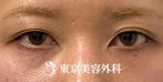 【眼瞼下垂・オープンアイズ、目の上の脂肪取り｜ak6893】の症例