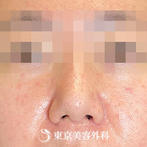 【鼻中隔延長、鼻尖形成、小鼻縮小｜gz15179】の症例