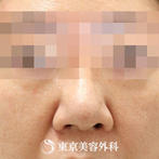 【鼻中隔延長、鼻尖形成、小鼻縮小｜gz15179】の症例
