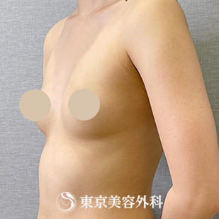 【豊胸手術（シリコンバック）｜ou118】の症例写真 before【3枚目】