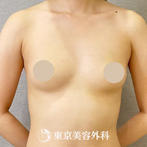 【豊胸手術（シリコンバック）｜ou118】の症例