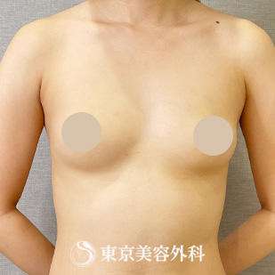 【豊胸手術（シリコンバック）｜ou118】の症例写真 before【1枚目】