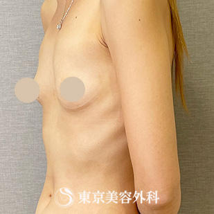 【豊胸手術（シリコンバック）｜ou156】の症例写真 before【3枚目】