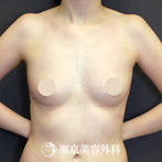 【豊胸手術（シリコンバック）｜si14613】の症例