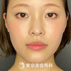 【鼻中隔延長、鼻尖形成、隆鼻｜yo194】の症例