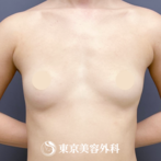 【豊胸手術（シリコンバック）｜ok809】の症例