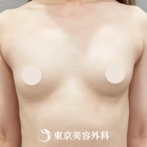 【豊胸手術（シリコンバック）｜fo418】の症例