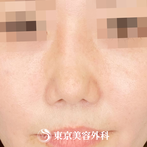 【鼻尖形成、鼻中隔延長、隆鼻術（他院修正）｜ng1684】の症例