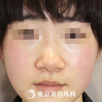 【小鼻縮小｜si16357】の症例