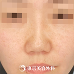 【鼻尖形成、鼻中隔延長、隆鼻術（他院修正）｜ng1684】の症例