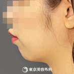 【顎ヒアルロン酸注入｜yo118】の症例