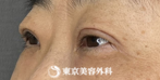 【眼瞼下垂、目の上のたるみ取り+脂肪取り｜ng4218】の症例