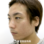 【鼻・頬・顎ヒアルロン酸｜si1777】の症例