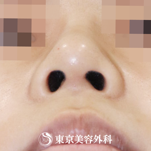 【鼻尖形成（切開法+軟骨移植）、隆鼻術（オーダーメードプロテーゼ）｜fy10783】の症例写真 after【6枚目】