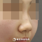 【鼻中隔延長（肋軟骨）、隆鼻術（オーダーメードプロテーゼ）、鼻骨骨切り、鼻翼縮小｜as4616】の症例