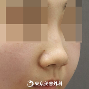 【鼻中隔延長（肋軟骨）、隆鼻術（オーダーメードプロテーゼ）、鼻骨骨切り、鼻翼縮小｜as4616】の症例写真 before【1枚目】