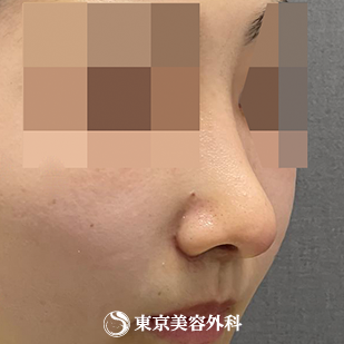 【鼻中隔延長（肋軟骨）、隆鼻術（オーダーメードプロテーゼ）、鼻骨骨切り、鼻翼縮小｜as4616】の症例写真 after【2枚目】