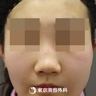 【鼻中隔延長（肋軟骨）、隆鼻術（オーダーメードプロテーゼ）、鼻骨骨切り、鼻翼縮小｜as4616】の症例写真 before【3枚目】