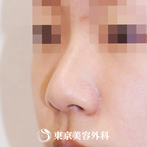 【鼻尖形成（切開法+軟骨移植）、隆鼻術（オーダーメードプロテーゼ）｜fy10783】の症例