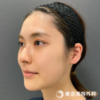 【顎矯正手術（OGS）｜ta4306】の症例