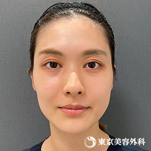 【顎矯正手術（OGS）｜ta4306】の症例写真 after【6枚目】
