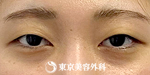 【眼瞼下垂（挙筋短縮法）、目の上のたるみ取り｜ak6659】の症例写真 before【1枚目】