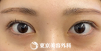 【眼瞼下垂（挙筋短縮法）、目の上のたるみ取り｜ak6659】の症例