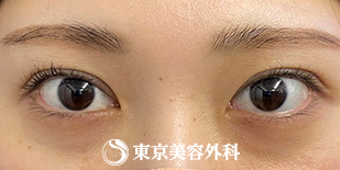 【眼瞼下垂（挙筋短縮法）、目の上のたるみ取り｜ak6659】の症例写真 after【2枚目】