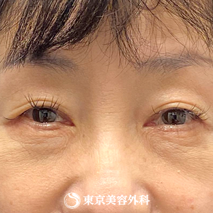 目の下のたるみ取り(ハムラ法)｜as5602の症例写真 after【2枚目】