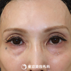 【目の下の脂肪取り、脂肪注入（目の下、頬、こめかみ）｜gz17303】の症例