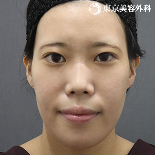 【顎矯正手術、下顎角形成｜as5026】の症例写真 before【1枚目】
