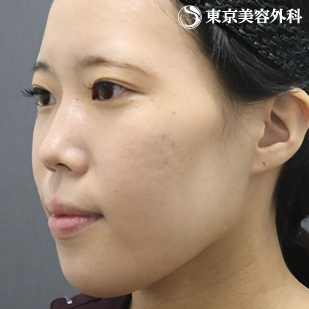 【顎矯正手術、下顎角形成｜as5026】の症例写真 before【3枚目】