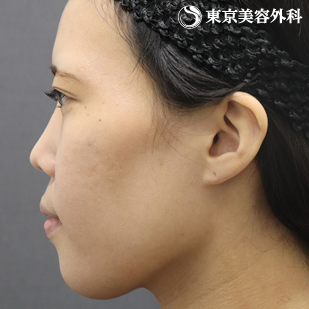 【顎矯正手術、下顎角形成｜as5026】の症例写真 before【5枚目】