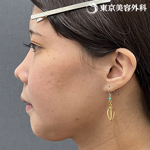 【顎矯正手術、下顎角形成｜as5026】の症例写真 after【6枚目】