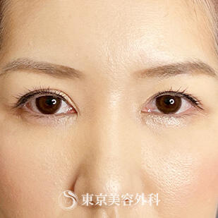 目頭切開の症例写真 after【2枚目】