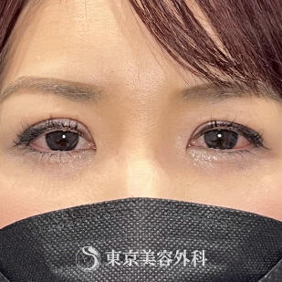 目頭切開の症例写真 before【1枚目】