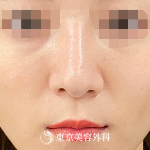 鼻プロテーゼの症例写真 after【2枚目】
