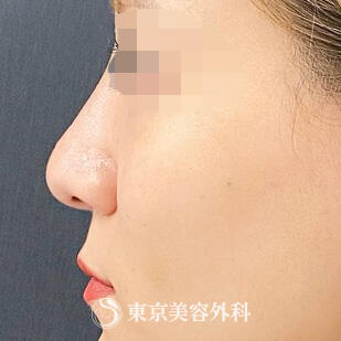 鼻プロテーゼの症例写真 after【6枚目】