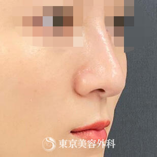 鼻プロテーゼの症例写真 after【4枚目】