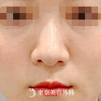 鼻プロテーゼの症例