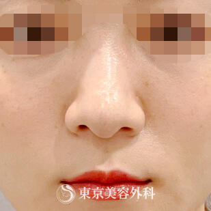 鼻プロテーゼの症例写真 before【1枚目】