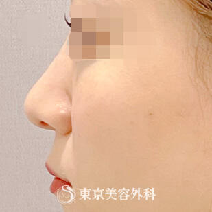 鼻プロテーゼの症例写真 before【5枚目】