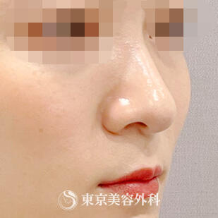 鼻プロテーゼの症例写真 before【3枚目】